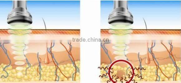 Antifreeze membranes multifunctional criolipolisis / cryolipolysis antifreeze membrane for freeze fat machine