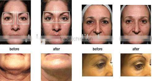 advanced radio frequency technology to provide optimal skin contraction in the deep layers of your skin