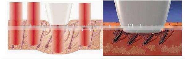 Germany DILAS laser bar laser hair removal upper lip hair removal machine/epila laser hair removal