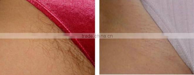 high level diode laser hair removal machine