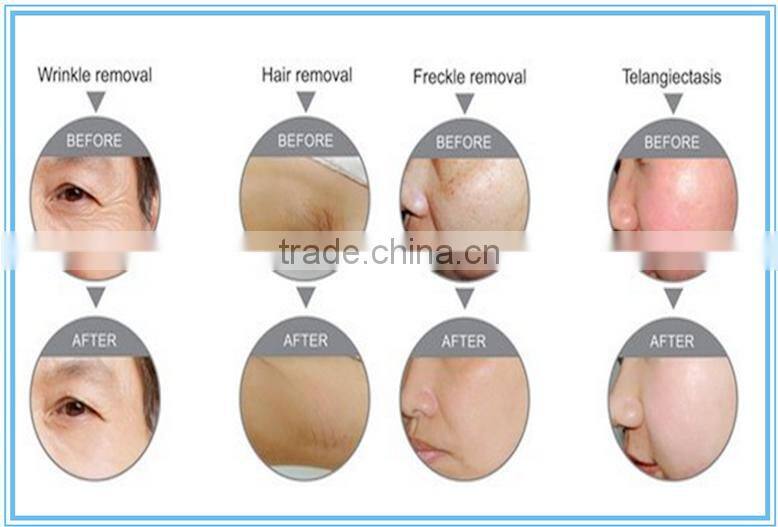 10 milliion shots lazer hair removal 808nme light laser hair removal machine