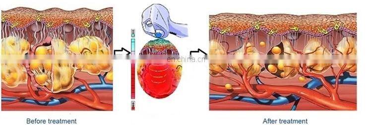 2 in 1 Vacuum cavitation system fat cutting Ultrasound RF weight loss machine
