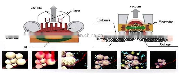 Best Seller 6 In 1 Vacuum Cavitation Machine Vacuum Cavitation System Cavitation RF Vacuum Slimming Machine