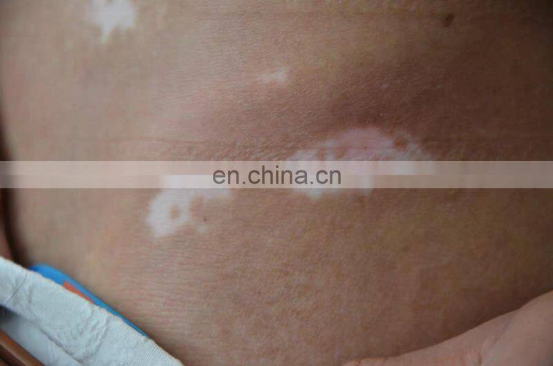308 nm excimer laser machine fototerapia dermatologia any new puva treatment psoriasis vitiligo light system india price