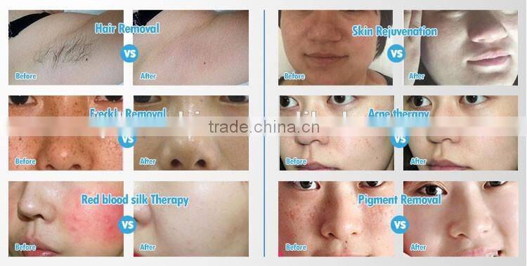 Newest high quality opt ipl portable hair removal