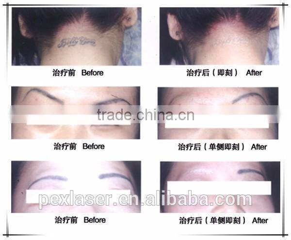 ND yag q-switched laser tattoo removal machine/1064nm