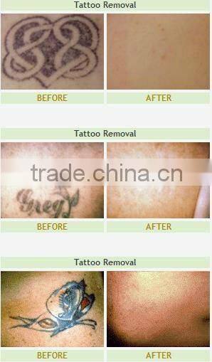 2012 Medical Tattoo Removal Laser with Active Q Switch