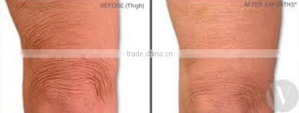 Hot Fractional & Micro needle RF machine for face lifting & skin rejuvenation