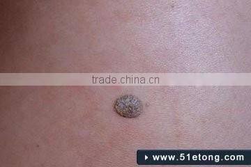 Micro Portable Handhold freckles removal pen