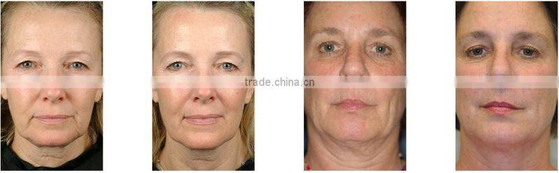 home use machine Newest Ultrasonic Derma Spa Facial Massager spot removal machine