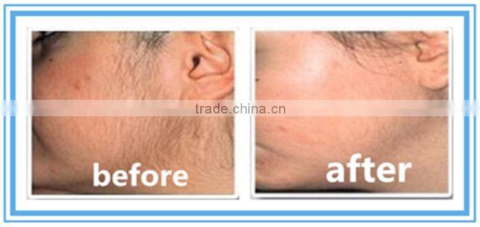 Alibaba express diode laser hair removal germany