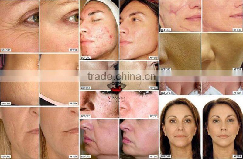 2016 OMEGA protable LED Skin Rejuvenation light/ pdt led for acne removal