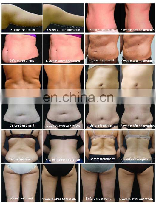 Multi-functional 360 cryo plates Fat Freezing Cellulite Removal Slimming Machine with 8 Pcs Cryo Pads