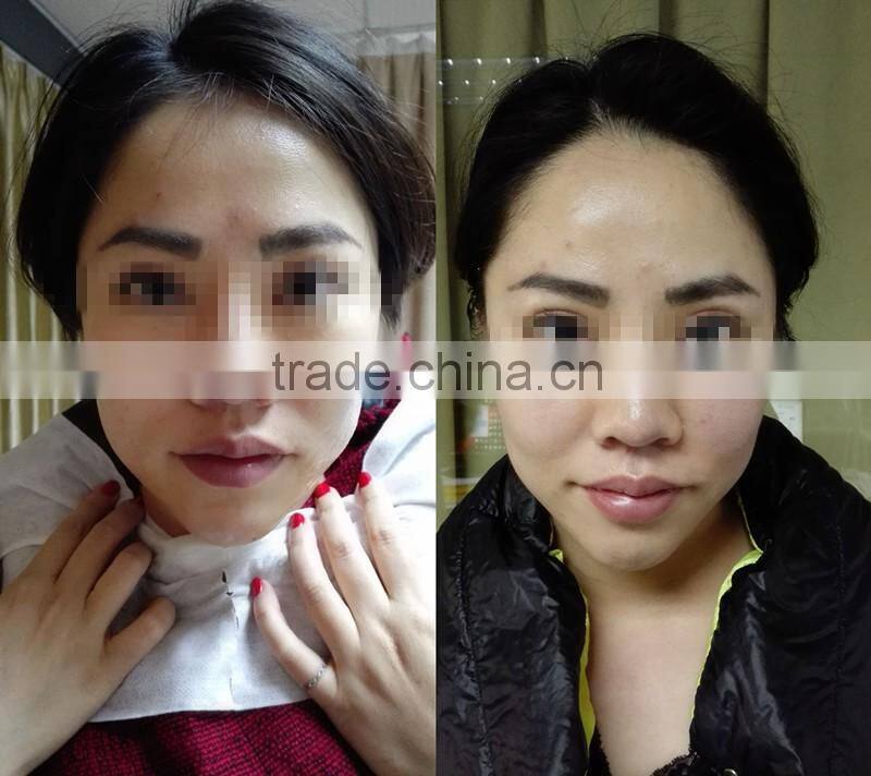 2016 Home Use HIFU Face Shape HIFU Machine