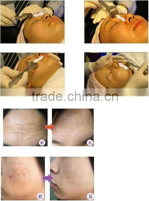 2014 new price LED photon derma roller L001 private label