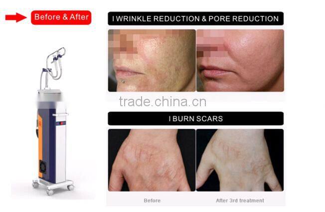 Hot skin tighten fractional rf machine microneedle skin wrinkle, wrinkle removal microneedle RF -MNF100
