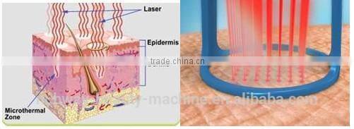 30000 Hours Long Life Time American RF Tube CO2 Fractional Laser