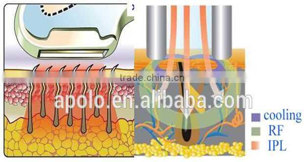 Fast and pain free hair removal IPL device with RF function for wrinkle removal and anti aging from Apolomed