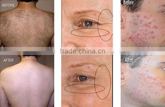 2016 most hot sale super hair removal ipl shr / shr ipl depilation / shr hair removal machine for sale