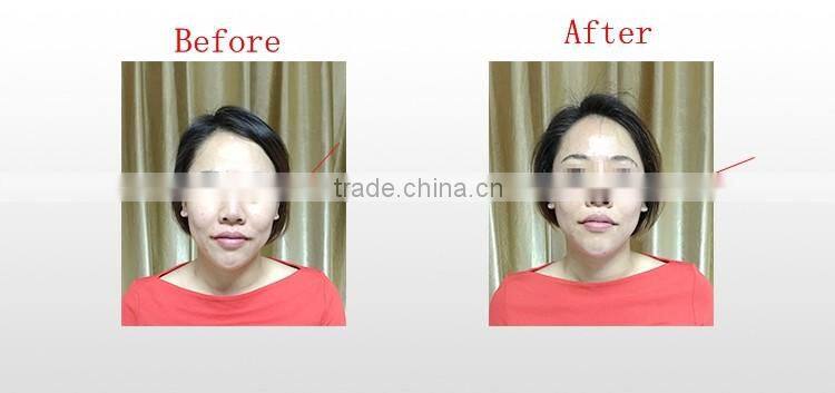 facial lifting fractional thermal rf high intensity focused ultrasound HIFU for face lifting and body
