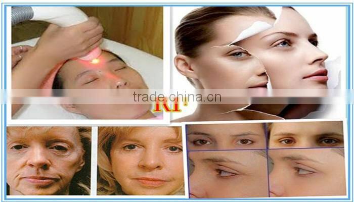 laser hair removal machine ipl hair removal yag 2016