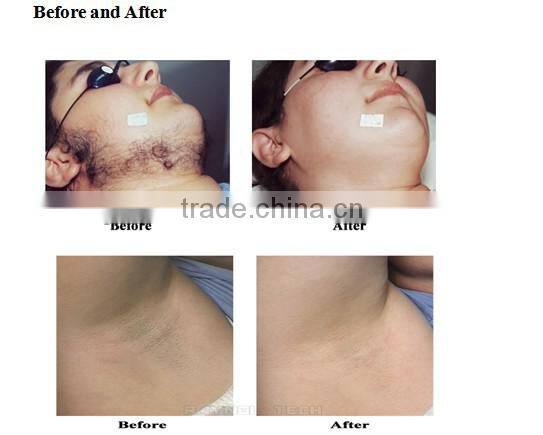 2015 Hot Sale in Clinic Permanent Hair Removal Machine IPL