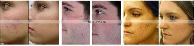 Hottest sale vaginal rejuvenation laser fractional co2 laser machine