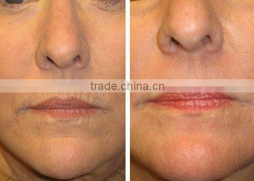 30000 Hours Long Life Time American RF Tube CO2 Fractional Laser