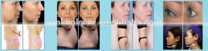 mini hifu / hifu high intensity focused ultrasound / hifu machine