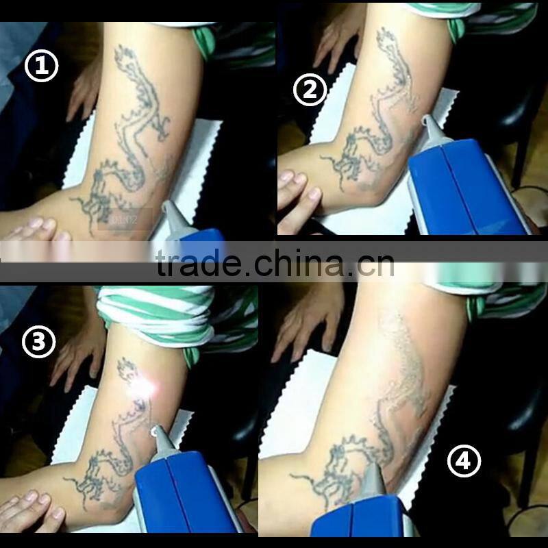 Laser Skin Care skin whitening tattoo removal machine TM-J116