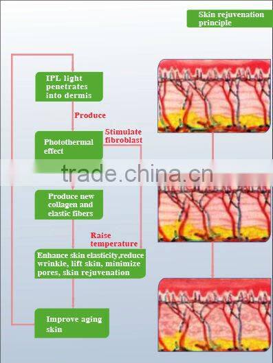 2015 top seller laser beauty equipment laser for hair loss
