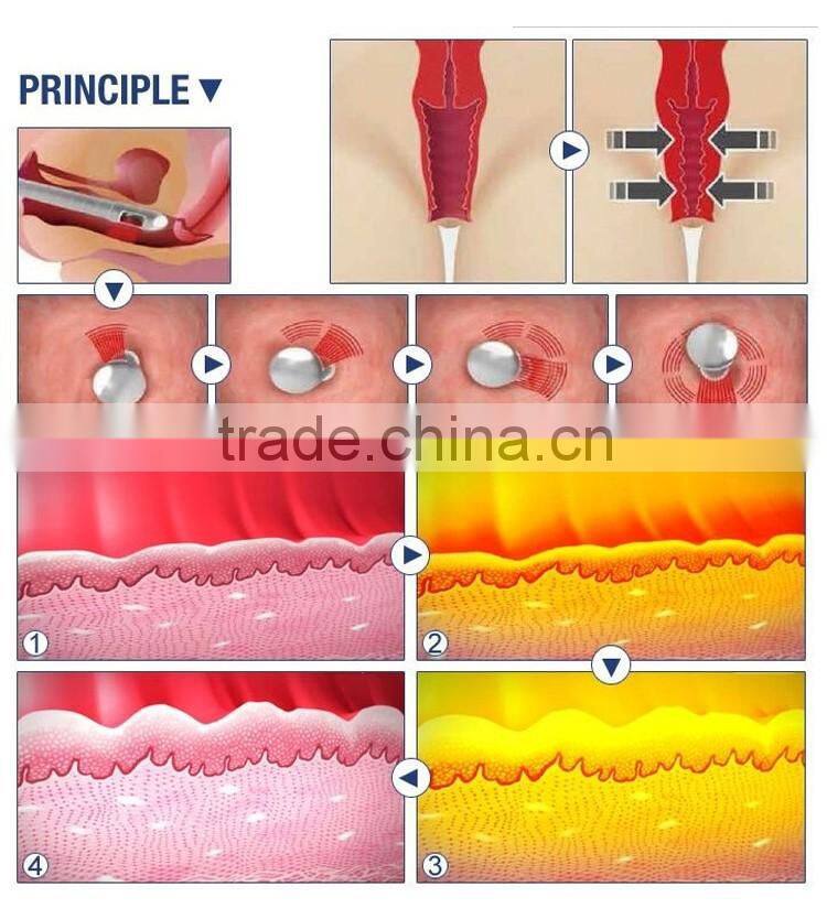 Non-invasive vagin tightening equipment