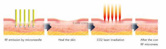 Personal care and beauty series product fractional rf skin lifting machine