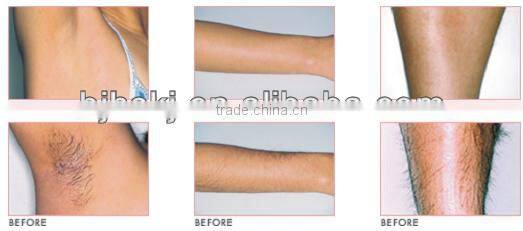 808nm diode vacuum shockwave therapy vacuum slimming machine