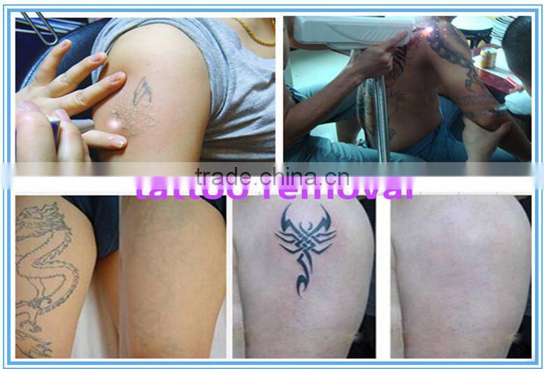 new technology nd yag laser tattoo removal machine