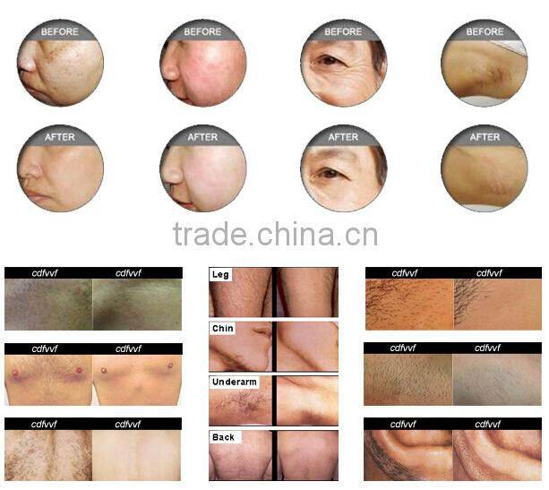 Permanent Laser Hair Removal Beauty IPL SHR Machine