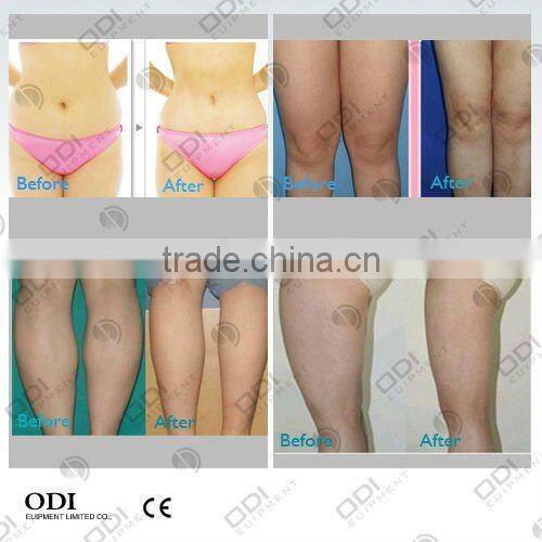 OD-S90 3-IN-1 Vacuum Radio Frequency System Cavitation Cellulite System Slimming Machine with CE