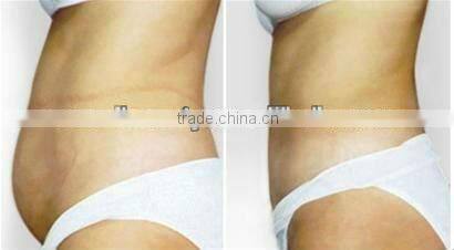 Fat loss machine laser liposuction weight loss beauty machine ultrasonic liposuction cavitation machine for sale
