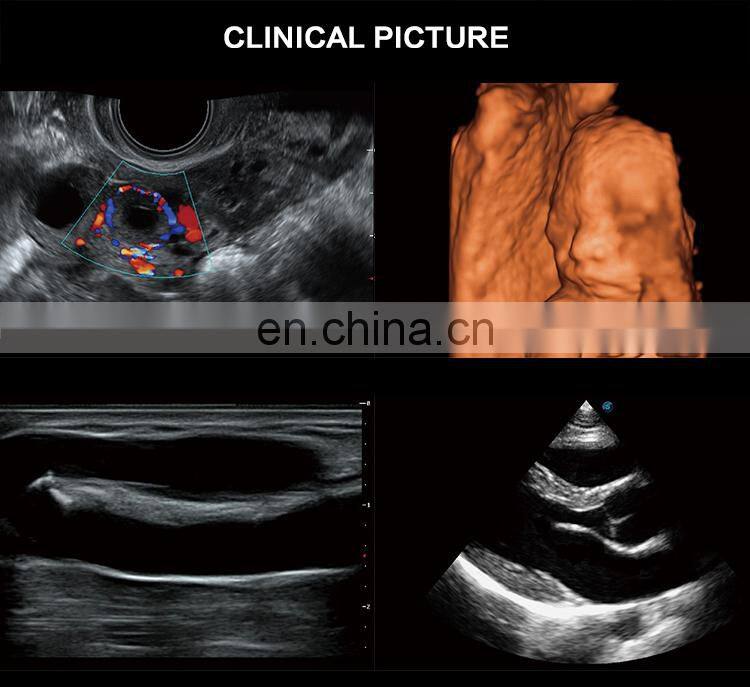 Latest Version Sonoscape P15 Trolley Color Ultrasound machine /cw color doppler ultrasound Sonoscape P15