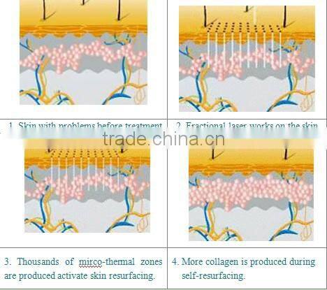 Professional Skin Resurfacing medical fractional co2 laser beauty machine