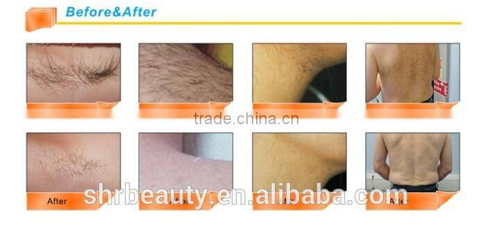 IPL SHR professional laser hair removal with high quality