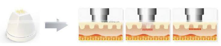 professional and high quality radio frequency rf machine for home use