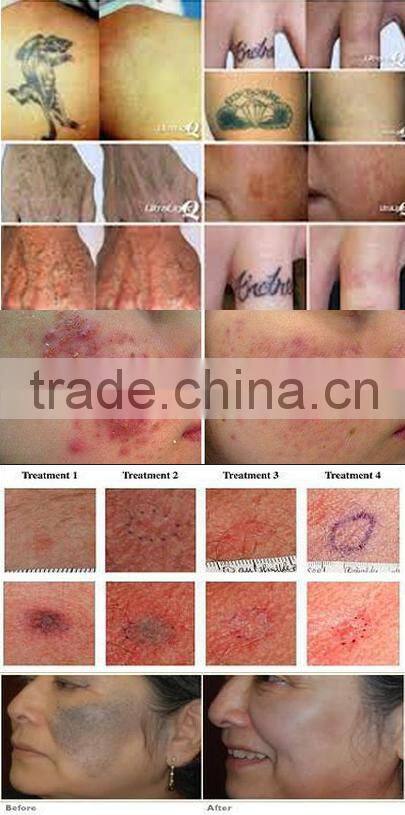 CE approved new handheld tattoo removal laser tattoo removal machine for sale q switch nd yag laser tattoo removal system