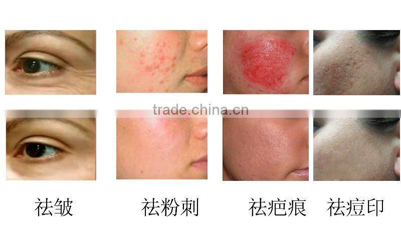 acne removal device fractional rf