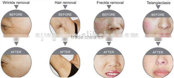 E-200 IPL hair removal machine chloasma removing