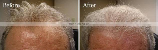 NL-SF650 Hair Rejuvenation 650nm Diode laser Anti Hair Loss treatment Hair Regrowth Brush Comb equipment with CE