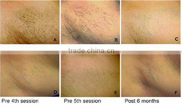 Permanent Laser Hair Removal Machine Diode Laser Cost of Laser Home Salon Use