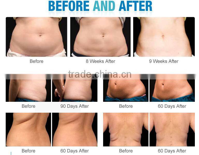 Cool tech fat 4 cryo handles fat freezing for weight loss body slimming