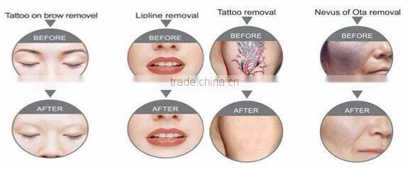 High quality laser beauty machine laser tattoo removal machine/nd yag laser equipment