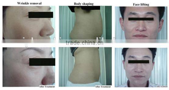 Aesthetic Equipment Ultrasonic Cavitation RF Vacuum Roller Massage body shaping machine